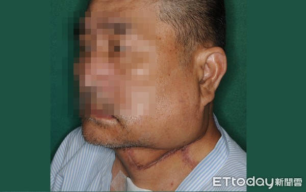 ▲阿龍罹患口腔癌四期透過手術、化療,重建口腔術後結果。(圖/記者謝承恩翻攝)