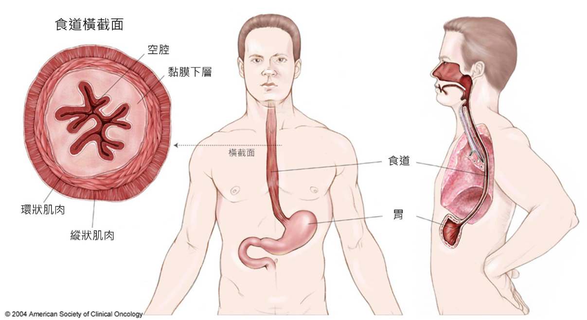 食道癌 胸部 癌症資訊 認識癌症 華人癌症資訊網 食道癌 胸部 癌症資訊 認識癌症 華人癌症資訊網